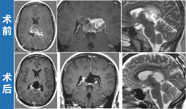 INC巴教授将肿瘤完全切除,同时保留了双侧胼胝体。术后,患者在数周内出现轻度记忆减退;此后,未出现任何神经或认知功能缺损,随访MRI显示肿瘤无复发。