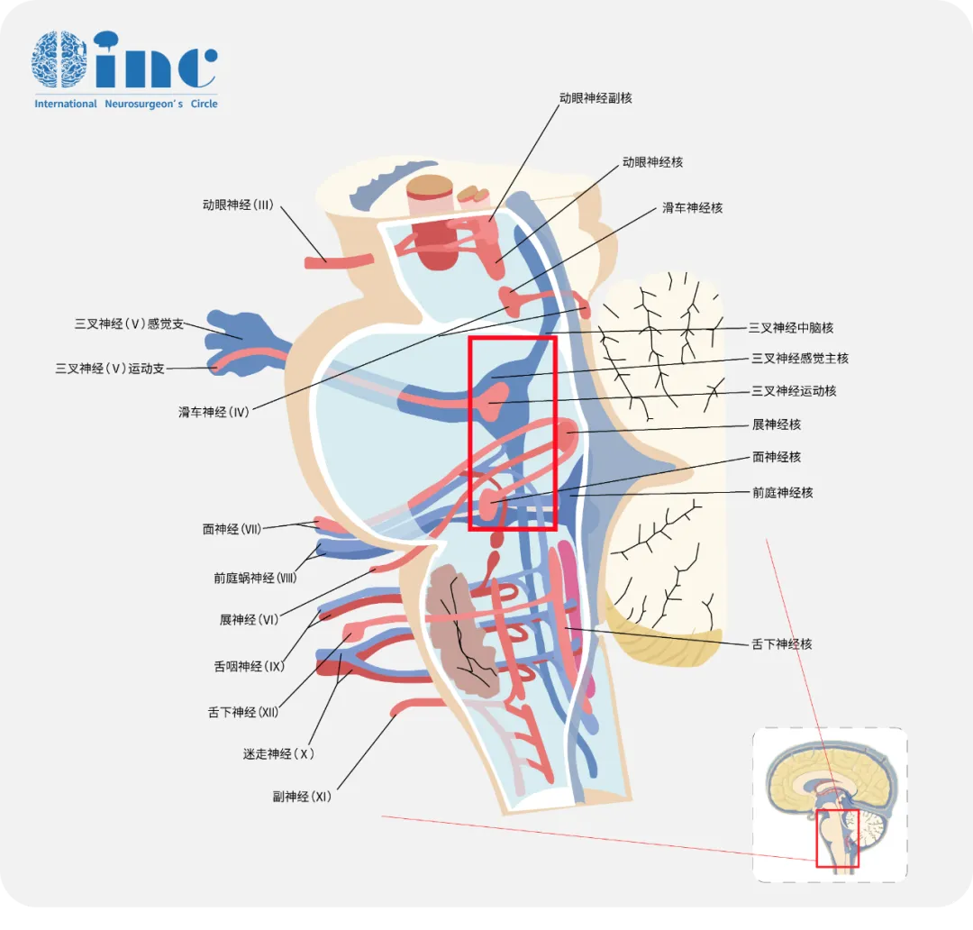 脑干神经肿瘤压迫症状