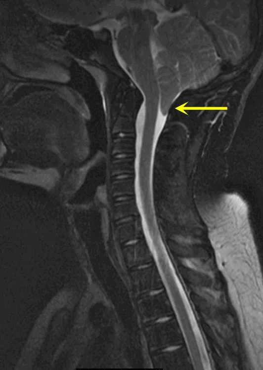 年轻运动员因头痛查出脑部畸形！为了重回赛场，他拼了！