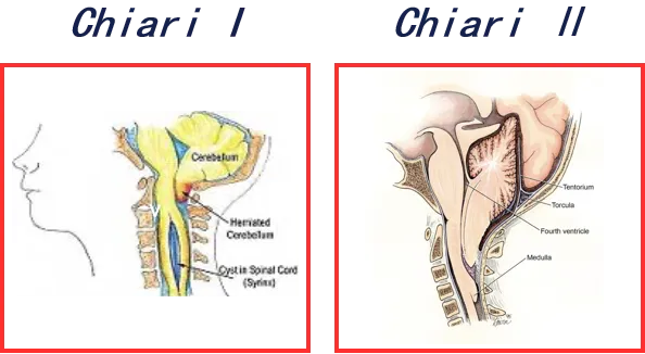▶▷ Chiari I型(CIM-I):最常见的类型,指小脑扁桃体向下延伸至枕骨大孔平面以下,超过枕骨大孔内缘连线 5mm,或 3-5mm 但已表现出相应临床症状者。  ▶▷ Chiari II型(CIM-II):指小脑蚓部向下延伸成疝,同时合并部分脑干下移及第四脑室延长,小脑扁桃体此时位于枕骨大孔及以下,常合并脑积水及脊髓空洞。