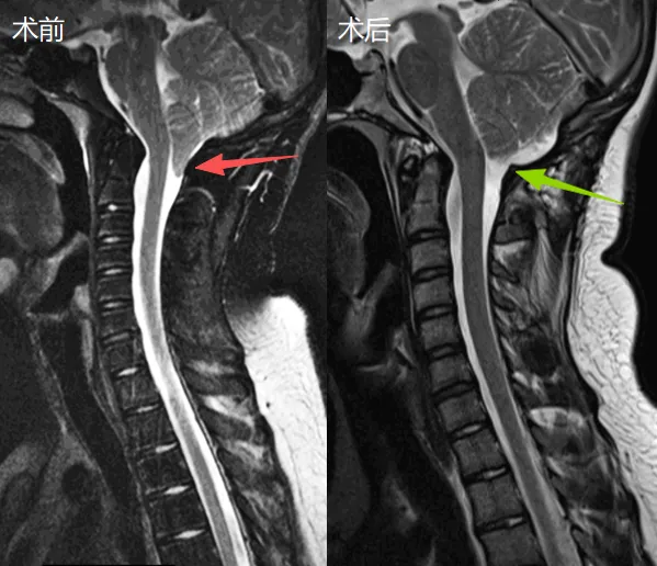 在Rutka(鲁特卡)教授的主刀下,手术十分顺利,约翰再也没有头痛发作