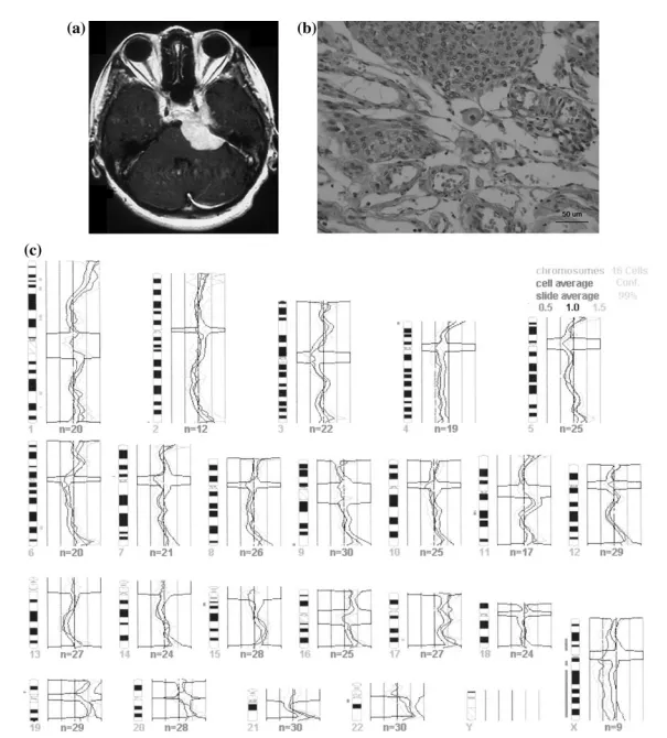同卵双胞胎先后确诊脑膜瘤？揭示NF2之外的新线索：X染色体的潜在作用