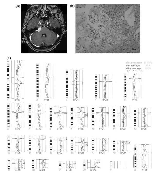 图2 a 钆剂增强T1加权磁共振图像，显示右侧桥小脑角区均匀强化病灶。 b 病例2标本显微照片（苏木精-伊红染色，×40），显示伴有血管瘤样成分的脑膜上皮型脑膜瘤。 c 病例2各染色体比较基因组杂交结果图谱。