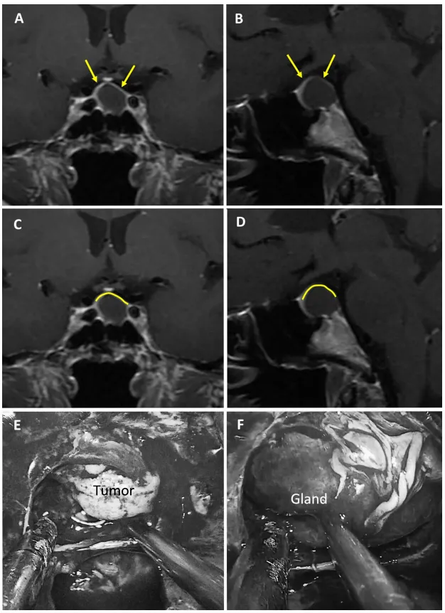 图2：75岁女性无功能大腺瘤患者。a、b术前MRI：黄色箭头指示厚度大于1毫米的强化屏障区。c、d术前MRI：黄色标记线标示强韧屏障位置。e、f术中图像：可见由垂体腺构成的屏障结构。