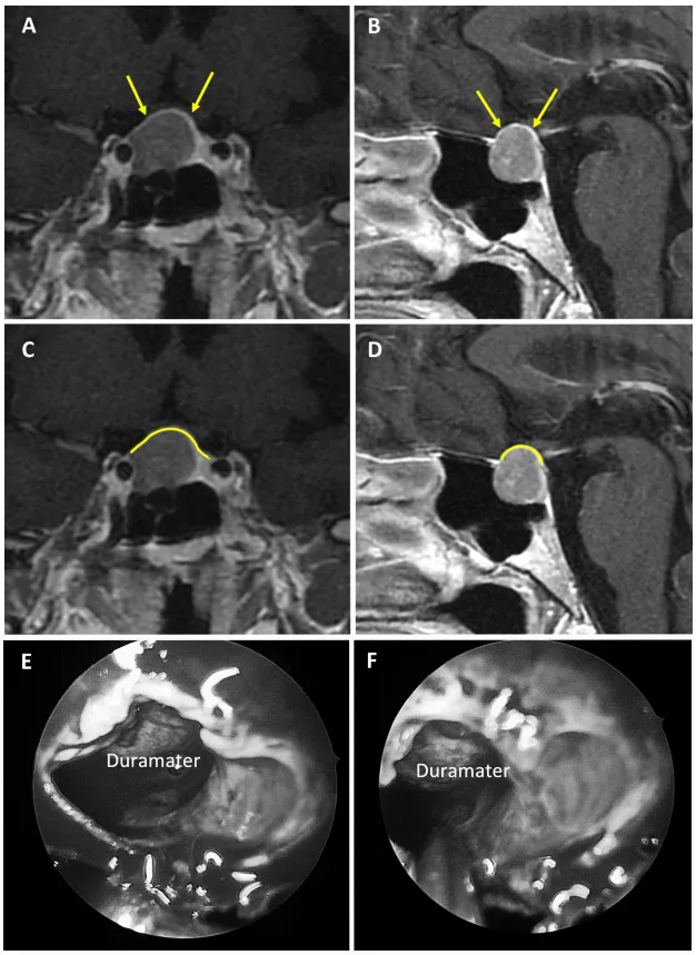 图3：67岁女性无功能大腺瘤患者。a、b术前MRI：黄色箭头指示厚度大于1毫米的强化屏障区。c、d术前MRI：黄色标记线标示强韧屏障位置。e、f术中图像：可见由硬脑膜构成的屏障结构。