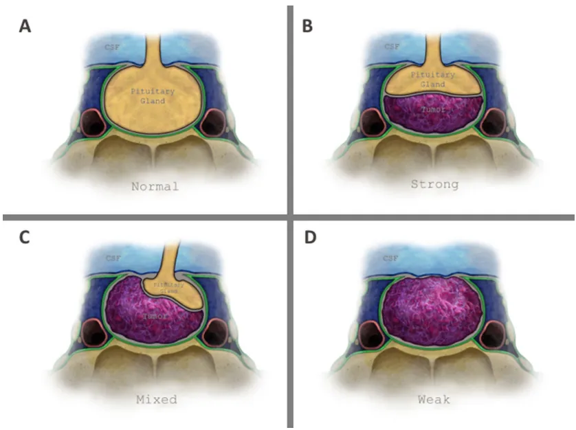 图1 垂体窝顶壁解剖结构及鞍隔屏障分型示意图。  a 无肿瘤状态下的正常解剖结构；b 强韧型鞍隔屏障：垂体腺和/或硬脑膜位于肿瘤与脑脊液之间。图示案例为单纯由垂体腺构成的强韧型屏障；c 混合型鞍隔屏障：肿瘤部分区域直接接触蛛网膜下腔，部分区域接触垂体腺；d 薄弱型鞍隔屏障：肿瘤与鞍隔顶壁全界面直接接触蛛网膜下腔。