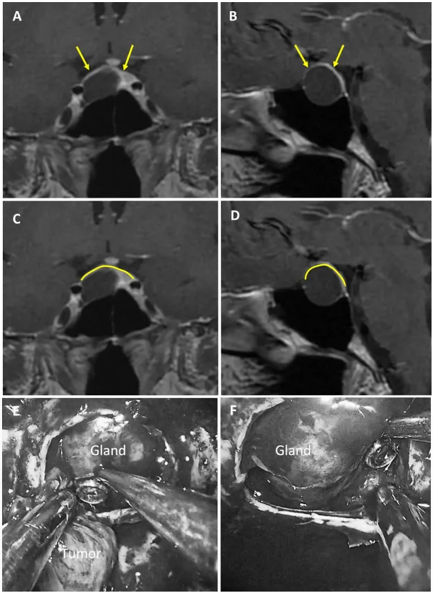 图4：47岁男性生长激素腺瘤患者。a、b术前MRI：黄色箭头指示厚度大于1毫米的强化屏障区。c、d术前MRI：黄色标记线标示强韧屏障位置。e、f术中图像：可见由垂体腺构成的屏障结构。