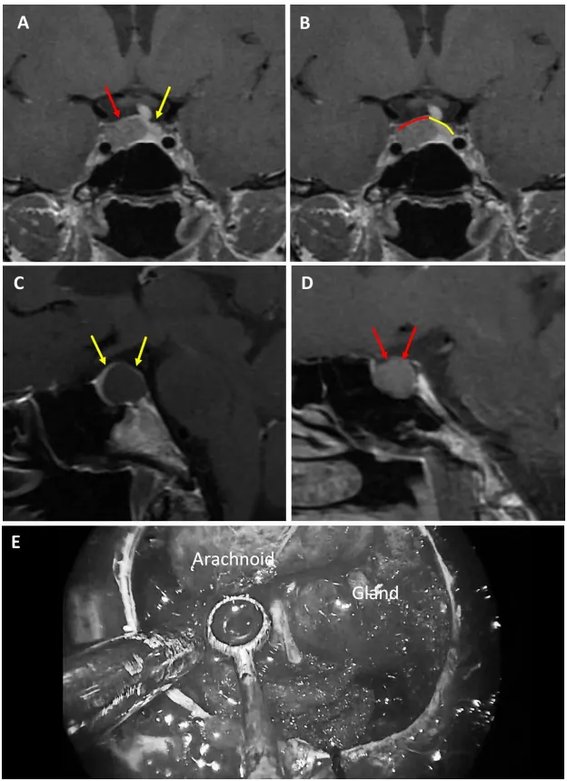 图5：56岁女性ACTH腺瘤患者。a、b术前MRI：黄色箭头指示厚度大于1毫米的强化屏障区，红色箭头指示厚度小于1毫米的薄弱屏障区。c、d术前MRI：黄色标记线标示强韧屏障区域，红色标记线标示薄弱屏障区域。e术中图像：可见由垂体腺与蛛网膜共同构成的混合屏障结构。