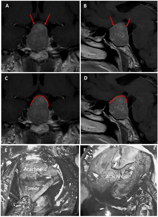 图6：59岁女性泌乳素腺瘤患者。a、b术前MRI：红色箭头指示厚度小于1毫米的强化屏障区。c、d术前MRI：红色标记线标示薄弱屏障位置。e、f术中图像：可见由蛛网膜构成的屏障结构。