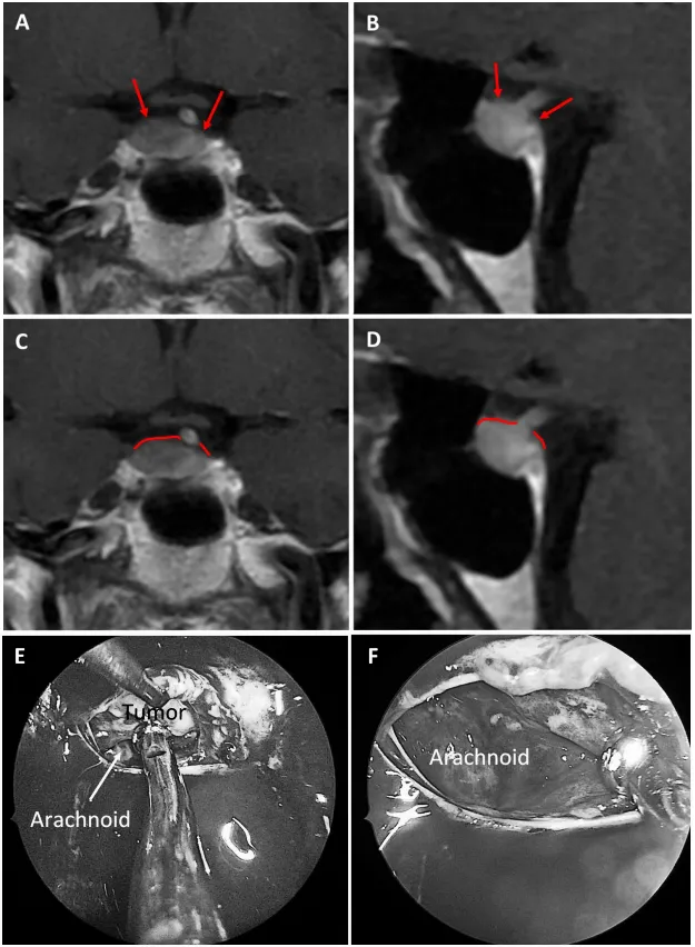 图7：69岁女性生长激素腺瘤患者。a、b术前MRI：黄色箭头指示厚度小于1毫米的强化屏障区。c、d术前MRI：红色标记线标示薄弱屏障位置。e、f术中图像：可见由蛛网膜构成的屏障结构。