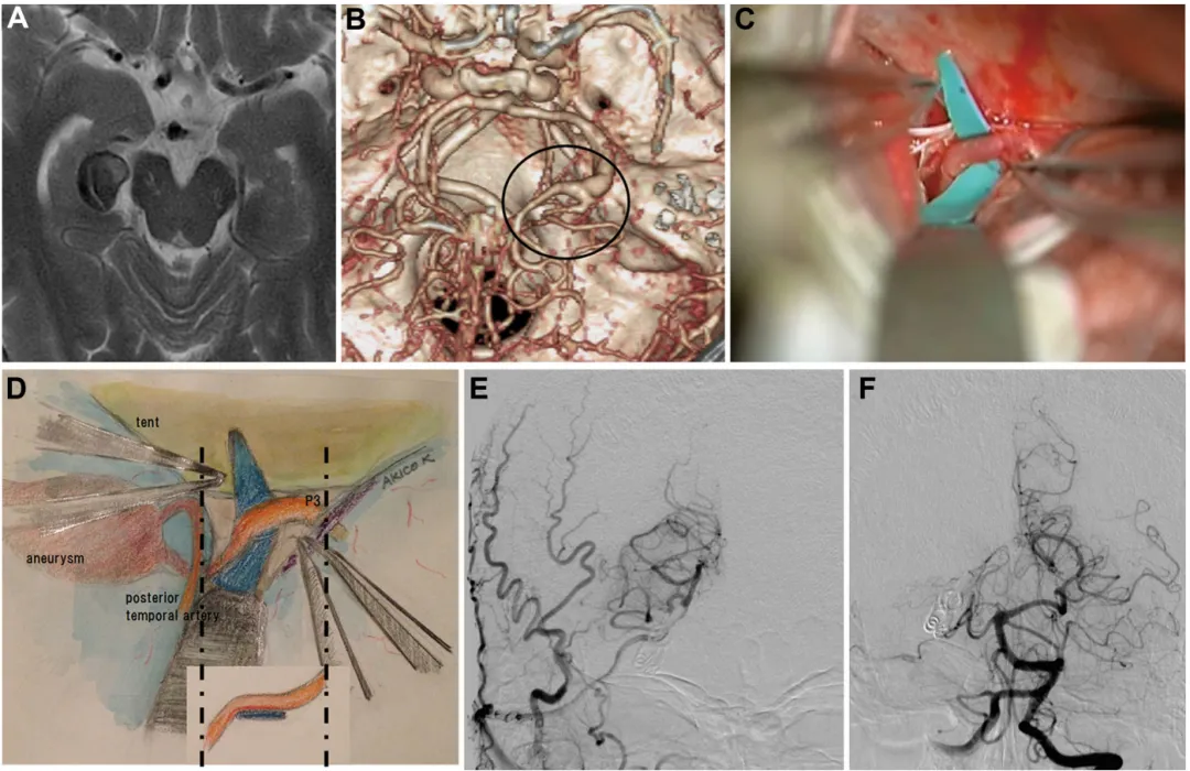 病例 1 ：术前影像（A、B）、术中照片（C、D）及术后血管造影（E、F）  A. MRI T2 加权像显示右侧环池内血栓性动脉瘤，压迫梭状回；  B. 三维 CT 血管造影显示右侧 P2 段梭形动脉瘤，颞后动脉及 P3 段起始部自动脉瘤远端发出（圆圈标注）；  C、D. 用橡胶片调整从深部向表面走行的 P3 段位置；  E、F. 术后血管造影显示通过分流血管，右侧大脑后动脉供血区血流良好，动脉瘤成功行外科孤立术。