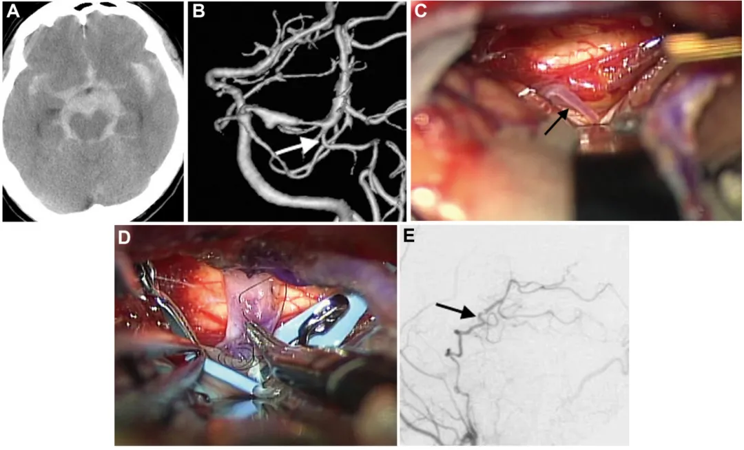 病例 2： 术前影像（A、B）、术中照片（C、D）及术后血管造影（E）  A. CT 显示弥漫性蛛网膜下腔出血，左侧脑桥前池增厚明显；  B. 出血后 18 天血管造影显示左侧 P1-P2 段扩张伴狭窄特征，颞后动脉自狭窄病变远端发出（箭头标注）；  C、D. 选择颞后动脉（箭头标注）作为受体动脉，经左侧颞下入路用连续缝合行颞浅动脉 - 颞后动脉吻合；  E. 术后 1 周颈外动脉血管造影显示，通过分流血管，整个左侧大脑后动脉供血区血流良好（箭头标注）。