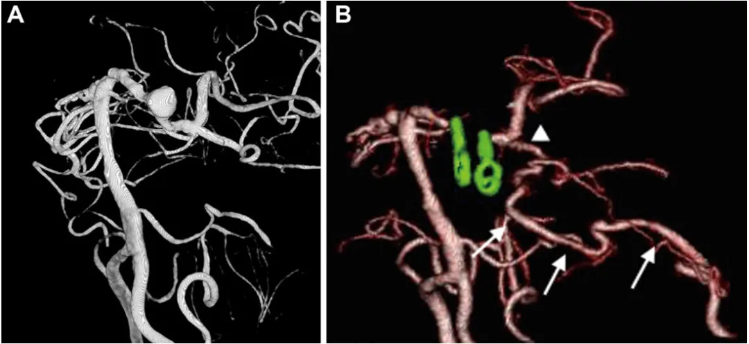 病例 3 ：术前（A）及术后（B）影像  A. 术前三维数字减影血管造影显示左侧 P1-P2 段交界处无分支动脉瘤；  B. 术后三维 CT 血管造影显示显示左PCA区域通过旁路（箭头）和PTA（箭头）有良好的血液供应。