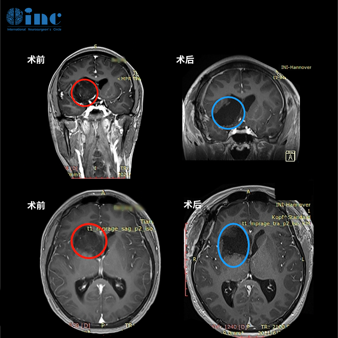 巴教授通过右侧额颞开颅暴露病灶,并在保护神经功能情况下最大程度切除肿瘤,随后借助术中 MRI 对照进行了显微外科肿瘤切除术,手术过程中未出现并发症,最终完成肿瘤的近全切。