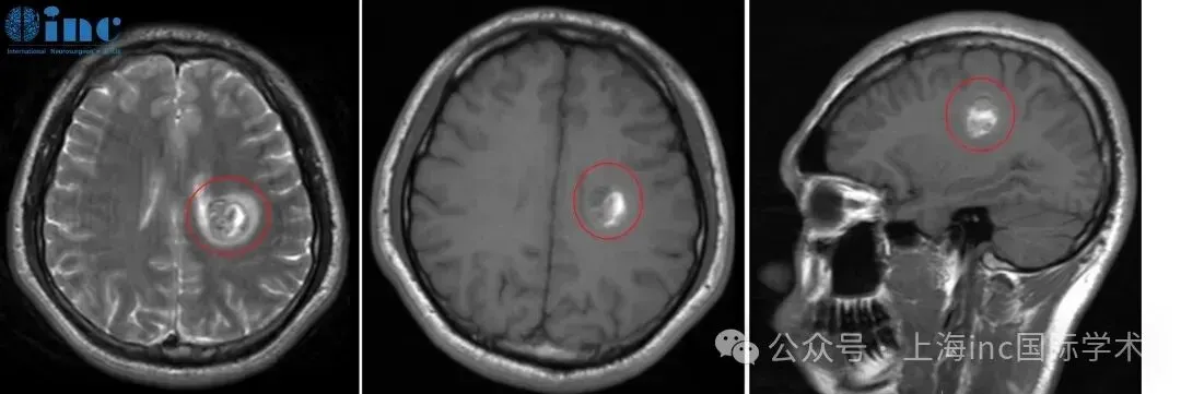 2022年5月，检查MRI影像，血管畸形处于急性出血期
