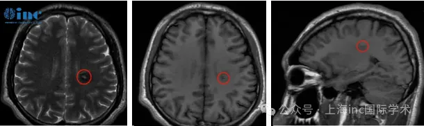 2023年4月，检查MRI影像
