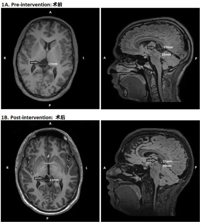 图2 颅内蛛网膜囊肿手术前后MRI对比（扫描间隔12个月）。（A）术前轴位与矢状位图像：箭头指示位于丘脑及顶盖区的蛛网膜囊肿，可见明显占位效应；（B）术后6个月轴位与矢状位图像：箭头显示囊肿经开窗减压术后体积显著缩小。