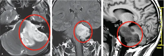 图a、b、c显示H先生脑干巨大占位,累及左侧桥脑、脑桥臂和小脑