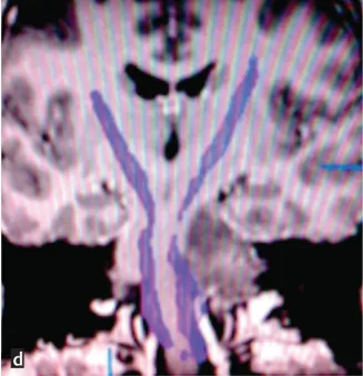 图d:术前扩散张量成像显示脑干肿瘤占位,压迫皮质脊髓束移位
