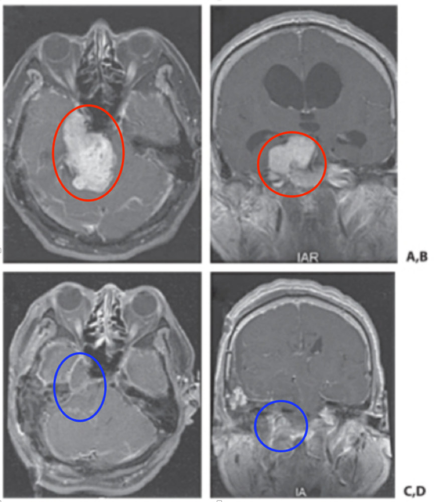 (A、B)术前MRI显示一个巨大的三叉神经鞘瘤伴脑干压迫,(C,D)术后MRI显示完全切除。