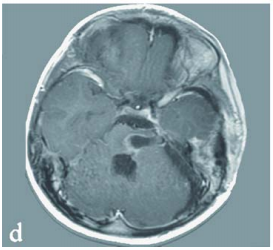 手术10天后进行的MRI检查证实海绵状血管瘤已被完全切除,并显示先前严重增大的脑干已得到减压,第四脑室恢复正常。