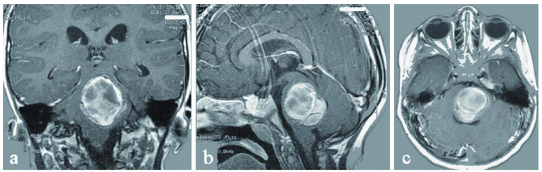3岁女儿急性脑出血被送上救护车,良性病变竟成“催命符”