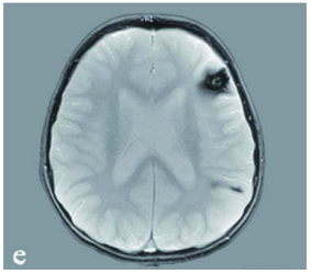 复查核磁显示,不仅原先的脑干海绵状血管瘤已生长到4×3.5×3cm,还在左额叶及顶叶也发现一个致痫病灶,同样是海绵状血管瘤。