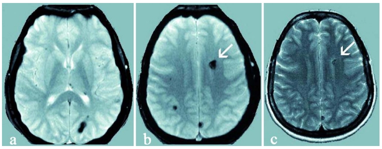 在楠楠母亲的核磁上,也发现了多个海绵状血管畸形的小病灶,但楠楠母亲至今并未出现任何症状。