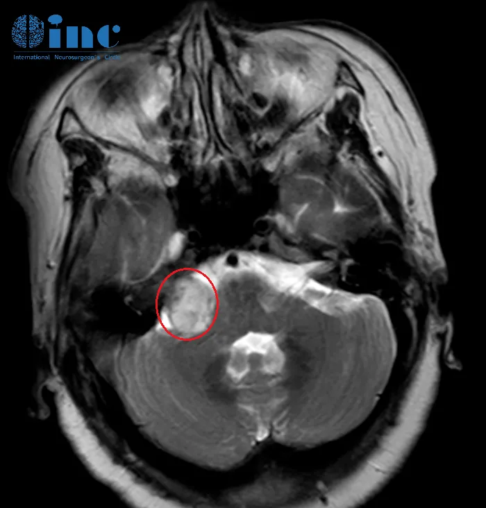 耳背、走路不稳,以为是“老年病”症状,检查一看竟是听神经瘤!