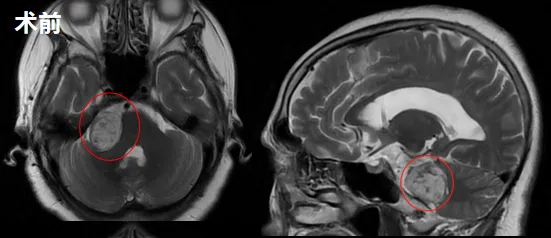 考虑到肿瘤体积较大，放疗可能效果不明显，3-4年后肿瘤很可能继续生长，届时患者年过八十，手术风险将大大增加。