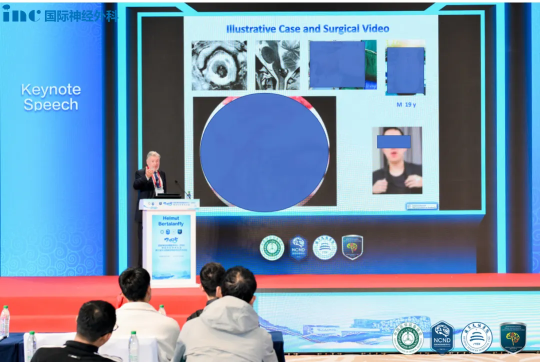 国内示范手术案例1,19岁-延髓海绵状血管瘤