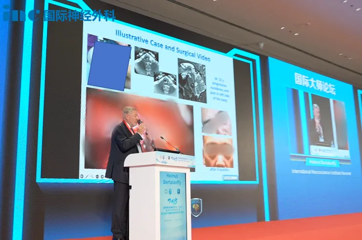 国内示范手术案例2,52岁-桥<a href='/naoxueguanliu/' target='_blank'><u>脑海绵状血管瘤</u></a>