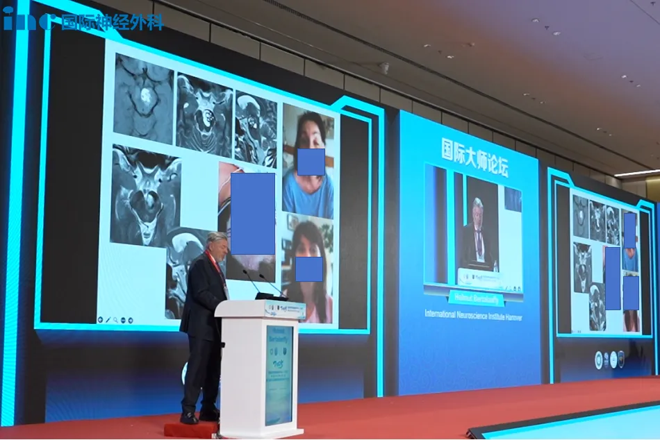 巴教授分享了下面这位患有很严重的左侧动眼神经麻痹的中脑海绵状血管瘤患者,病变严重压迫中脑。