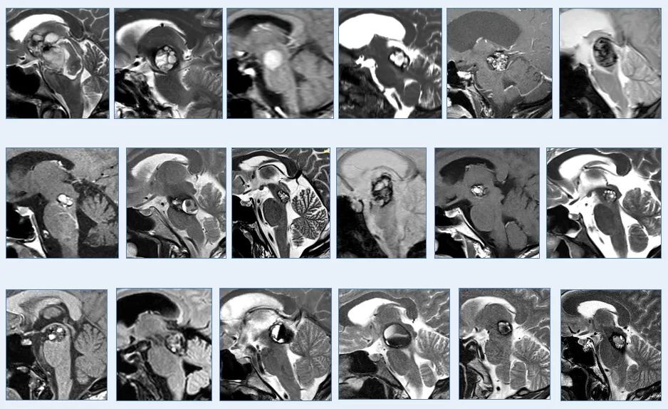 中脑海绵状血管瘤案例