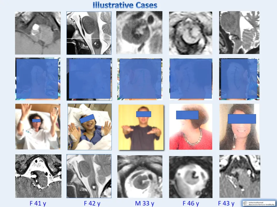 延髓海绵状血管瘤  手术技术及案例分享