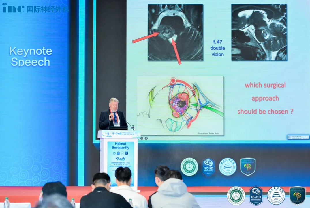 巴教授根据桥脑的解剖及病变的复杂关系总结了五大手术入路,包括:经髓帆入路、经桥脑臂入路、远外侧入路、小脑上外侧入路、颞下经天幕入路。