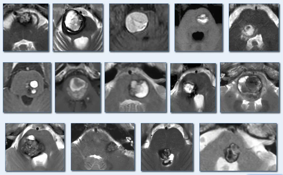 桥脑海绵状血管瘤案例
