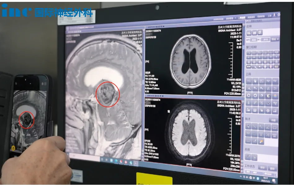 脑干海绵状血管瘤反复出血有多凶？是该冒险手术还是保守治疗？