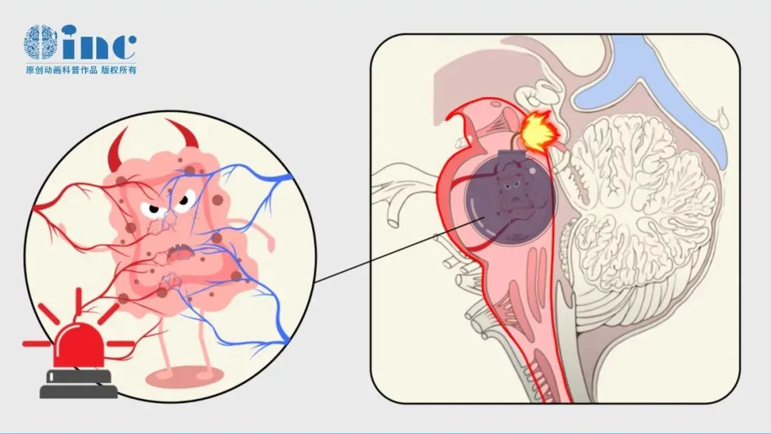 面对如此凶险的病灶，是冒险手术还是保守治疗？手术能否全切？术后会不会有严重并发症？