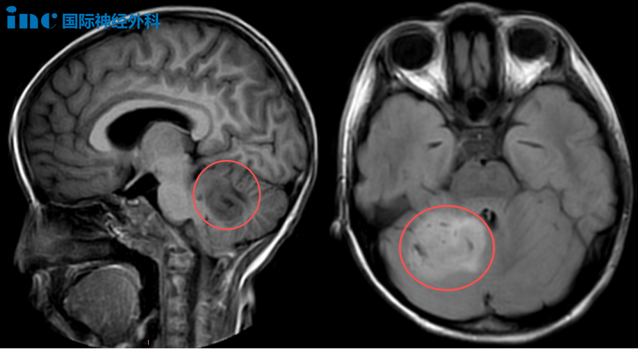 乐乐的右侧小脑存在异常信号,考虑为低级别胶质瘤。