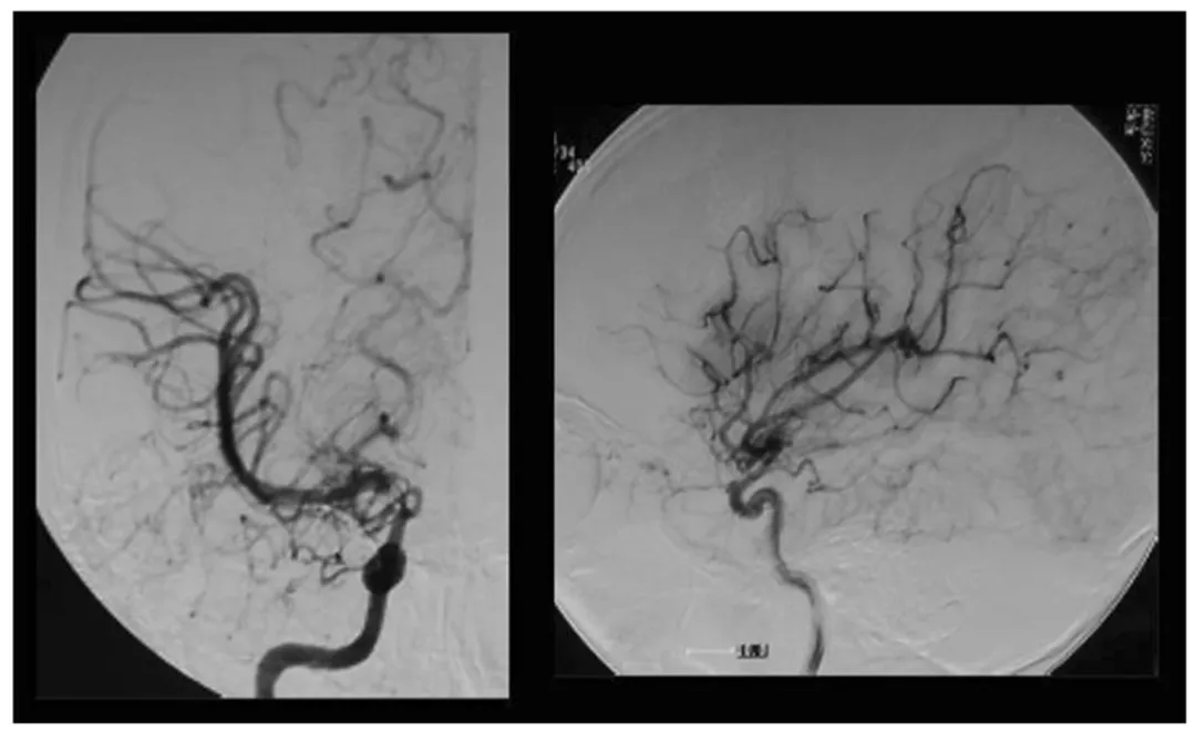 图1,术前右颈动脉血管造影显示IC末端顶部烟雾血管发育,左:前后视图,右:侧视图