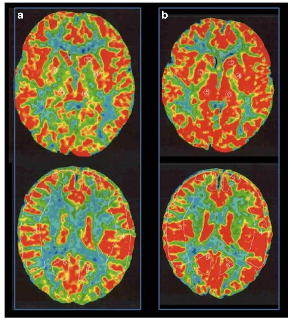 图2,术前脑血流检查显示显示静息状态下双侧脑血流无明显差异(a),注射乙酰唑胺后右侧大脑中动脉供血区脑血管反应性为 14.8%(b)