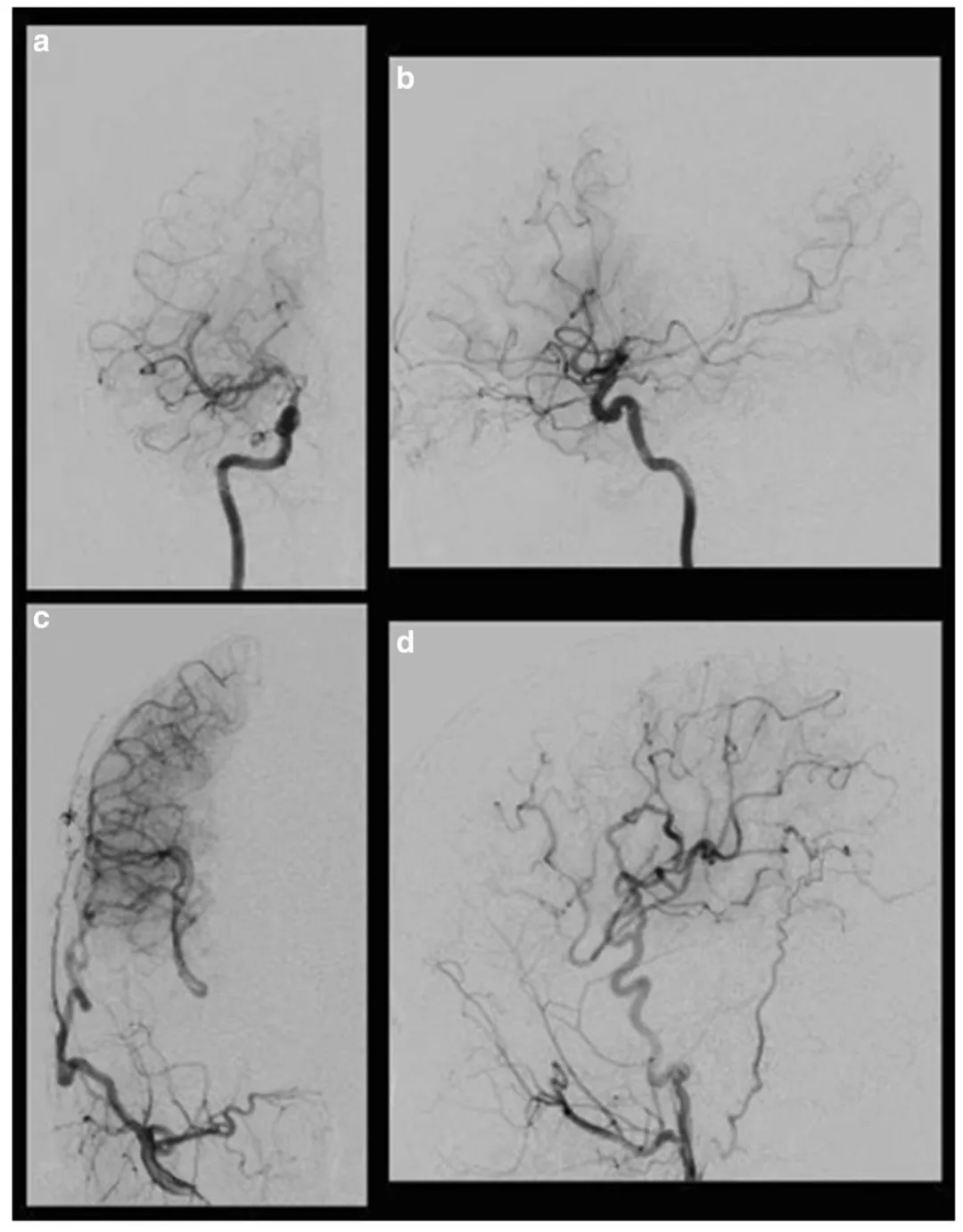 图三,术后右侧颈动脉血管造影显示,通过右侧颈外动脉的搭桥血管向大脑中动脉(MCA)和大脑前动脉(ACA)供血不足区域供血。右侧颈内动脉正位观(a)和侧位观(b);右侧颈外动脉正位观(c)和侧位观(d)