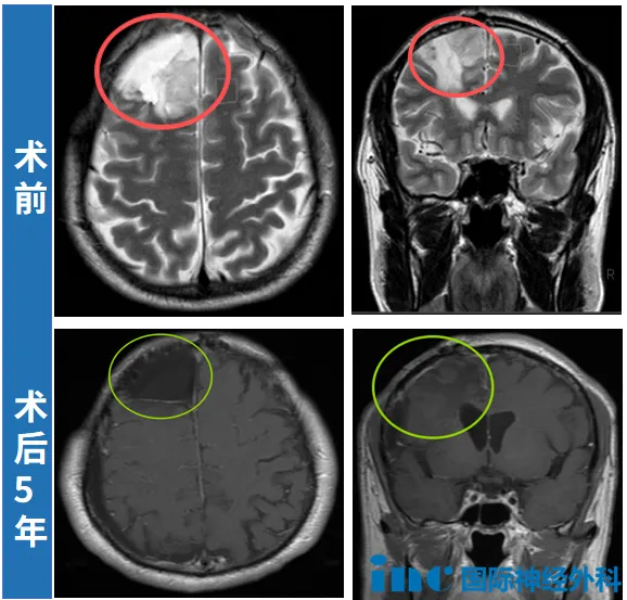 复发后胶质瘤从二级恶化为三级，选择再次手术的他终于回归理想生活！