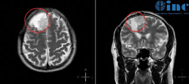 术后病理显示:右额少突胶质细胞瘤,WHO II级