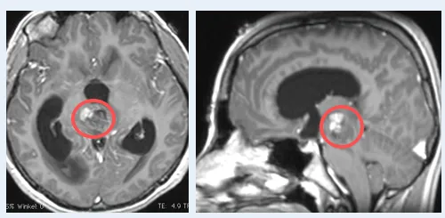 长在“手术禁区”的中脑海绵状血管瘤能完整切除吗？INC巴教授解读治疗关键点