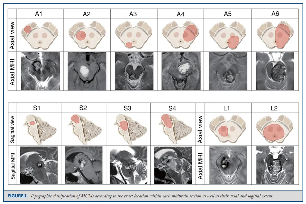 根据每个中脑部分内的确切位置及其轴向和矢状范围对MCM进行位置分类，然后采取不同的手术入路，这对术后效果至关重要
