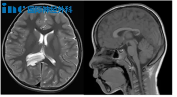霖霖的丘脑已被逐渐增大的肿瘤步步紧逼、推挤