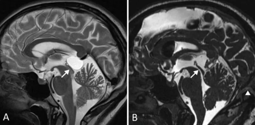术后正中矢状位MR CISS图像(B)显示:囊肿完全切除,中脑导水管通畅。开颅手术范围达横窦(箭头标示)。患者症状完全消失。