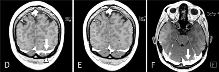 增强T1加权磁共振成像(冠状位D、E,轴位F):左侧优势静脉窦及桥静脉;据此选择静脉窦穹隆更高的右侧入路。